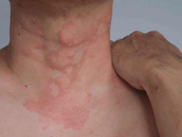 Ilustración de ronchas (habones) en la piel