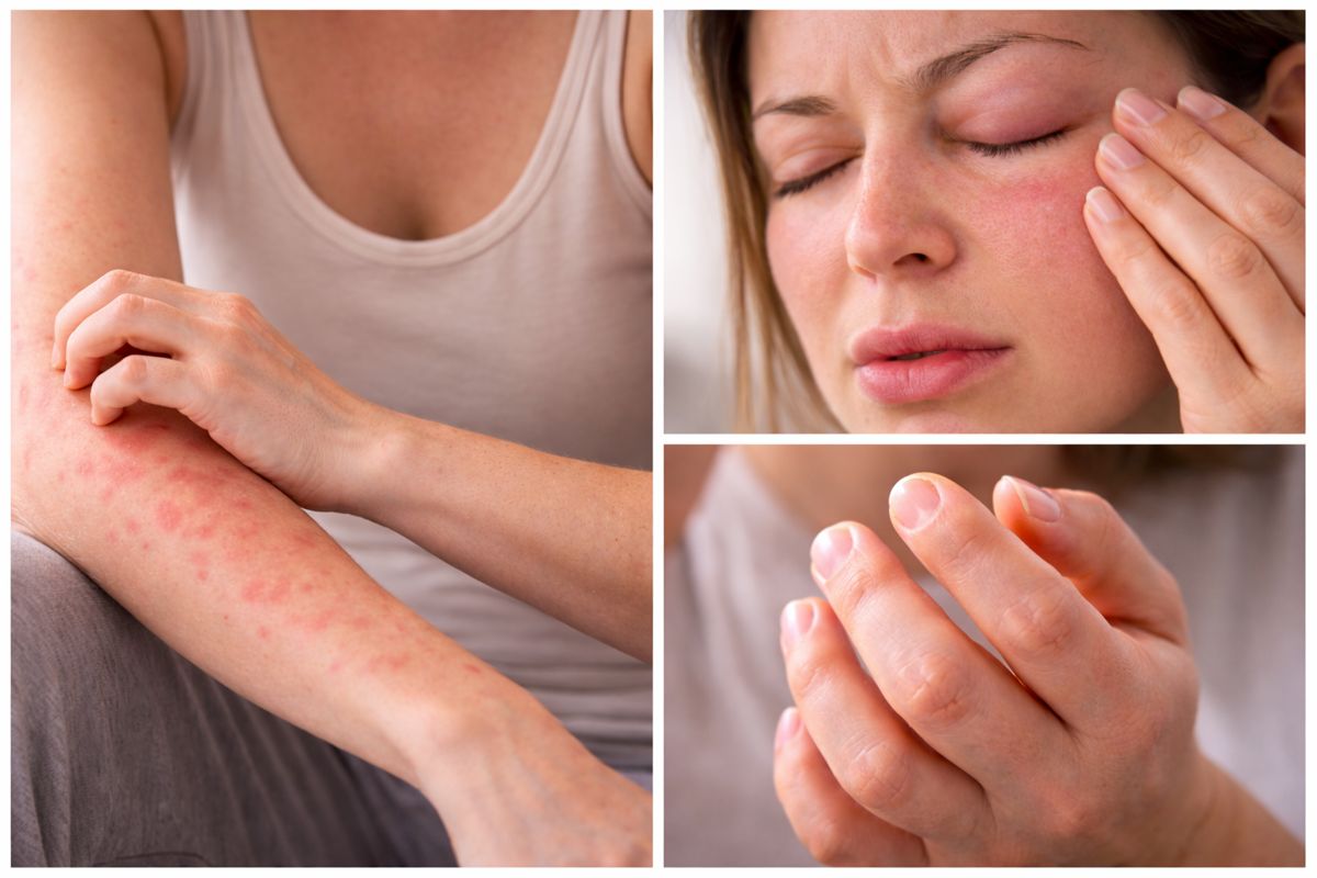 ¿Sabías que no todas las personas con urticaria crónica tienen los mismos síntomas?