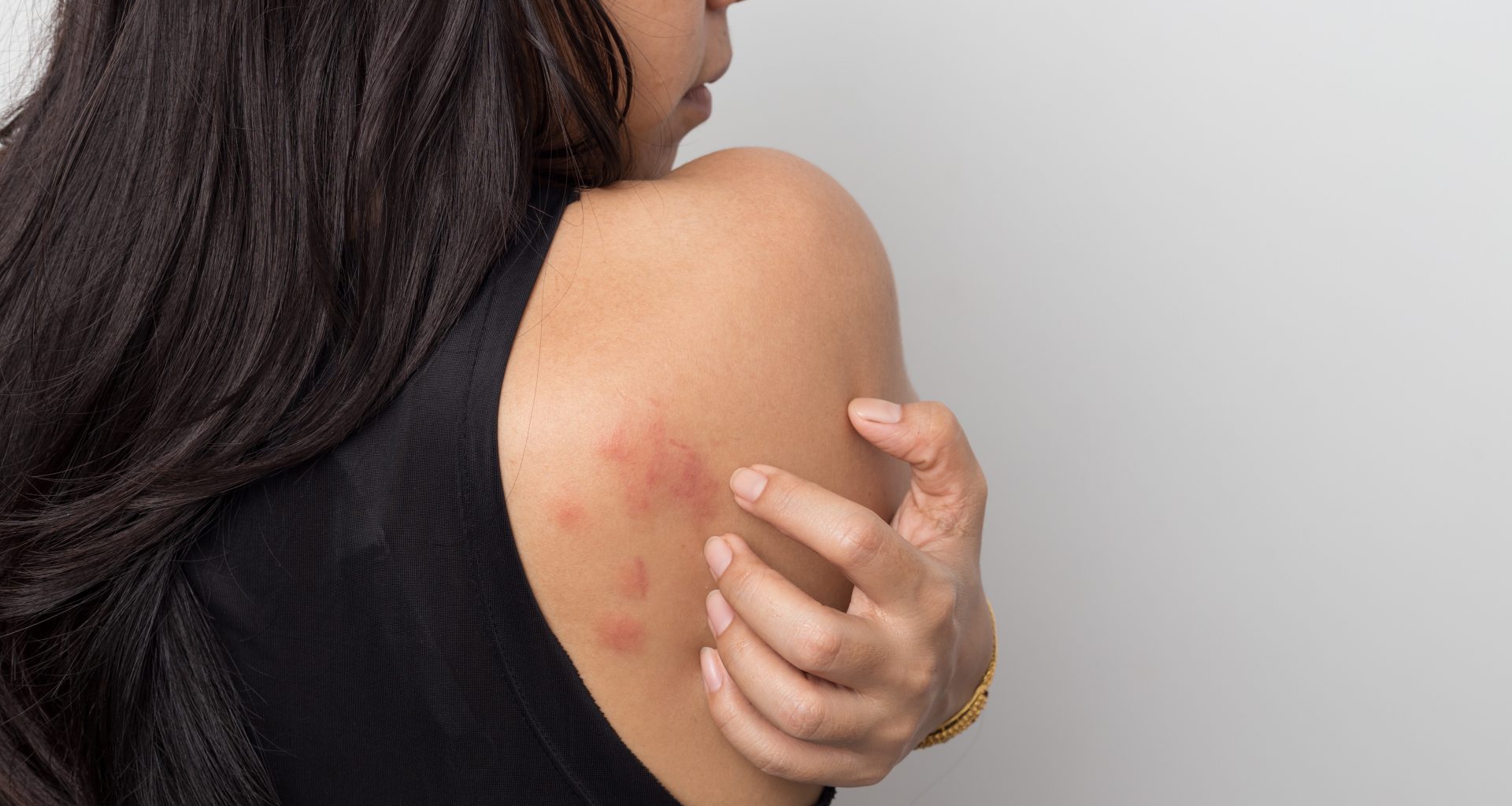 Urticaria crónica espontánea
